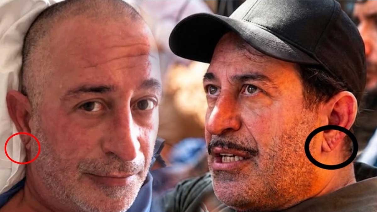 Kulak memesindeki çizgi (frank çizgisi) ne anlama geliyor, gerçekten kalp krizi belirtisi mi?