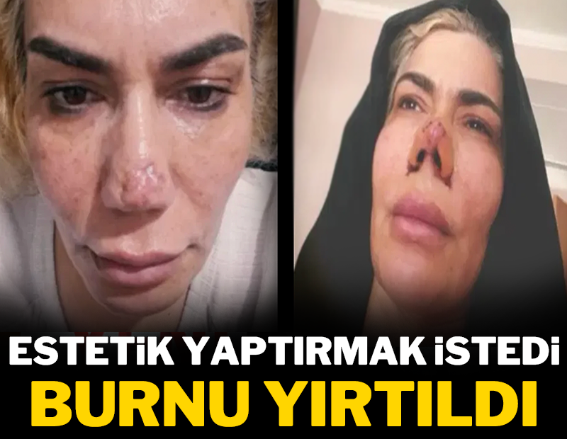Estetik yaptırmak istedi: Burnu yırtıldı!