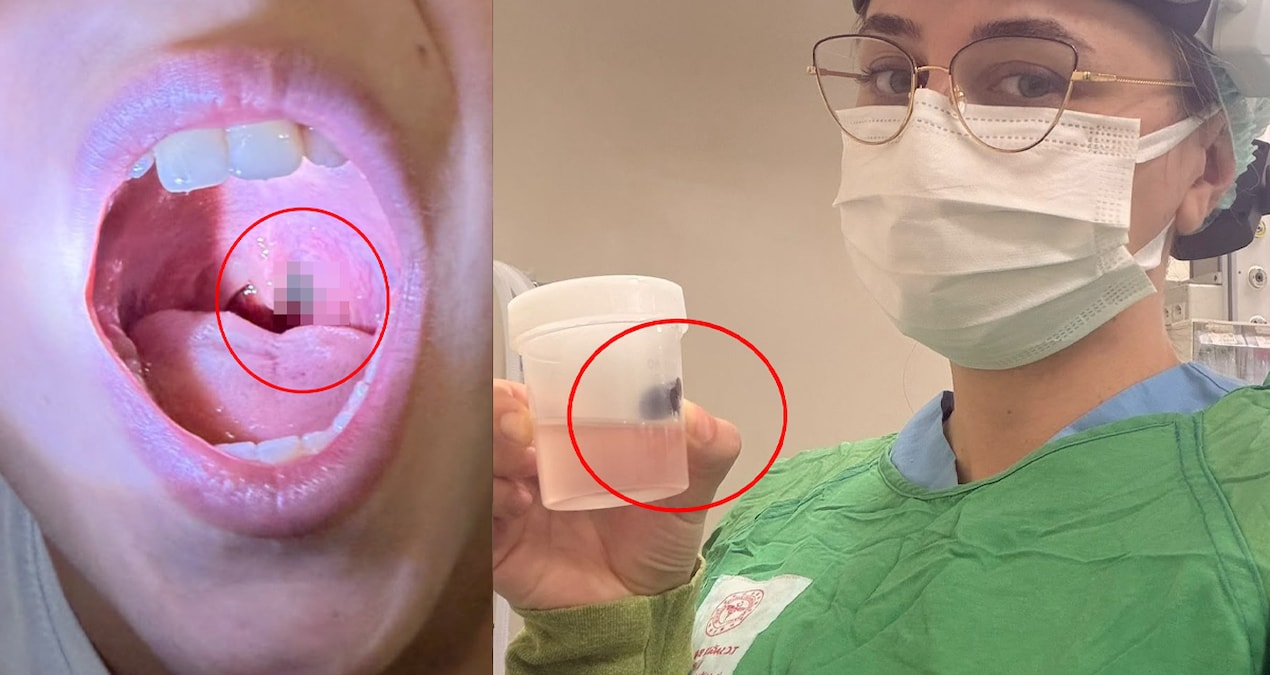 Burun kanamasıyla hastaneye gitti, boğazından çıkan şey doktorları bile şaşırttı